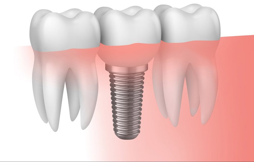 implantes-dentales-bilbao